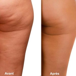 avant après ventouse cellulite