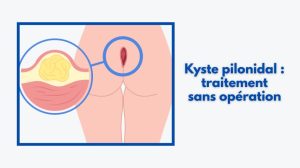 kyste pilonidal traitement sans opération