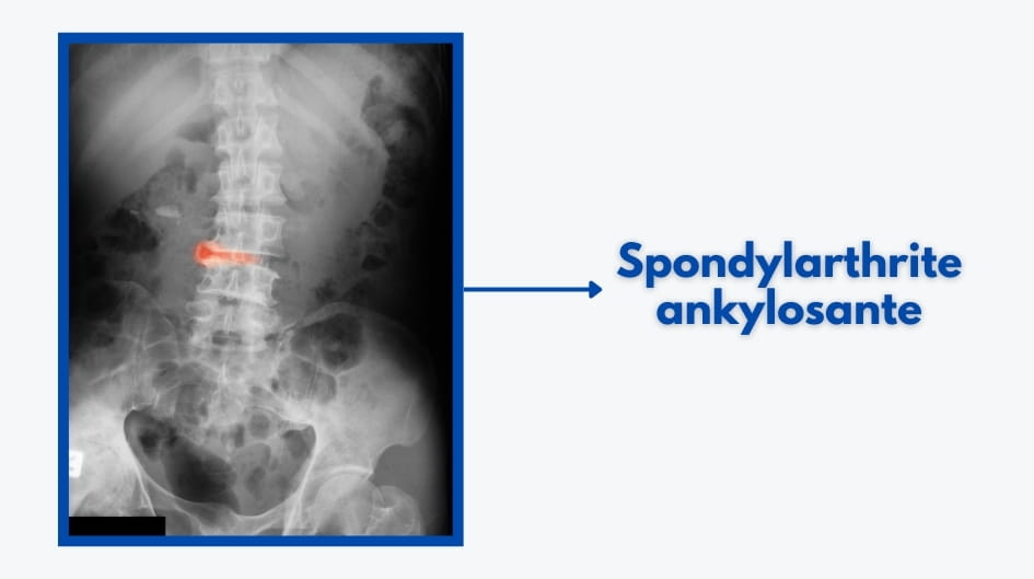spondylarthrite ankylosante radio